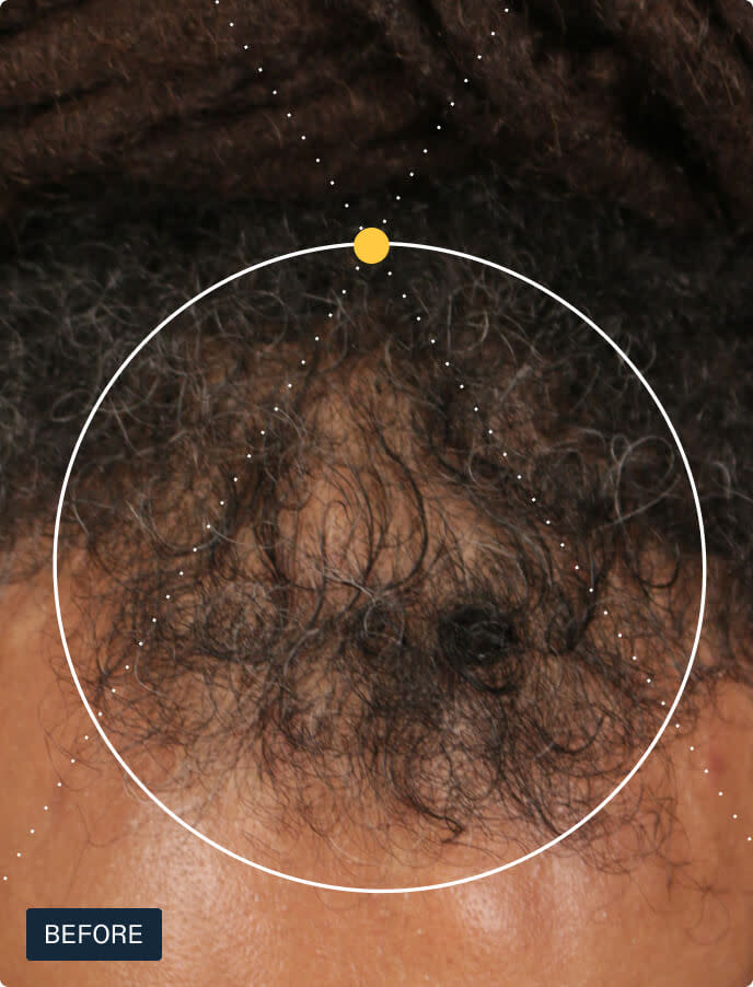Nutrafol Men——Supports visibly thicker, fuller hair and scalp coverage in men 18-49.1
