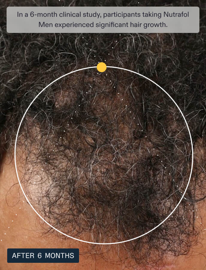 Nutrafol Men——Supports visibly thicker, fuller hair and scalp coverage in men 18-49.1