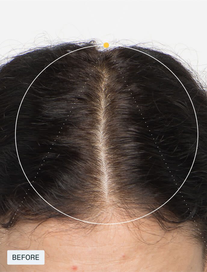 Women——For Women 18-44 experiencing signs of hair thinning